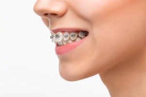 Beautiful young woman with teeth braces on gray