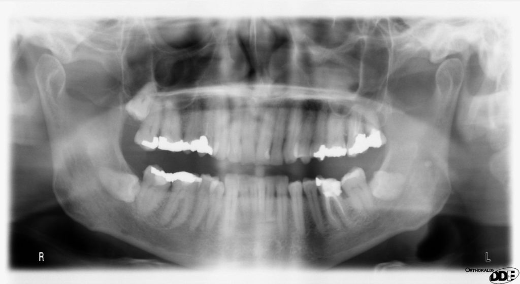 x-ray image of teeth