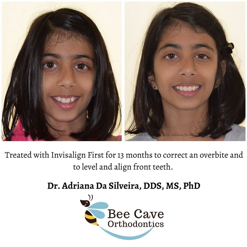 Bee Cave Orthodontics Invisalign for adults and kids in Austin