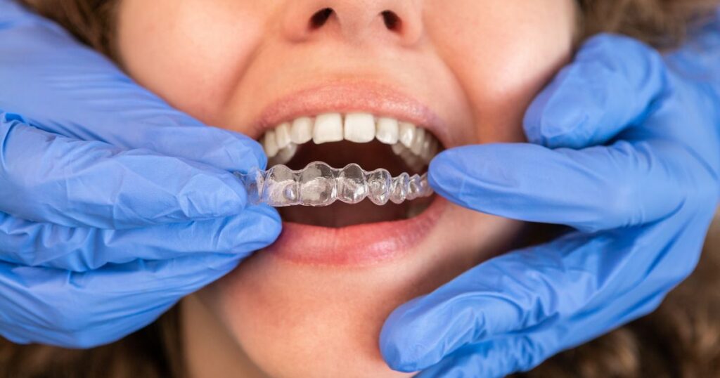 Bee Cave Orthodontics Invisalign for adults and kids in Austin