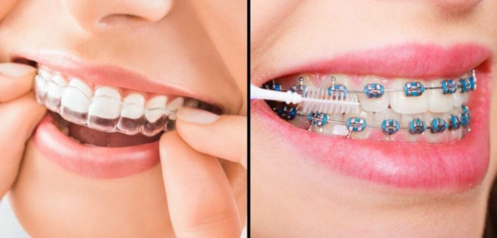 Types of Braces