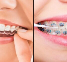 Types of Braces