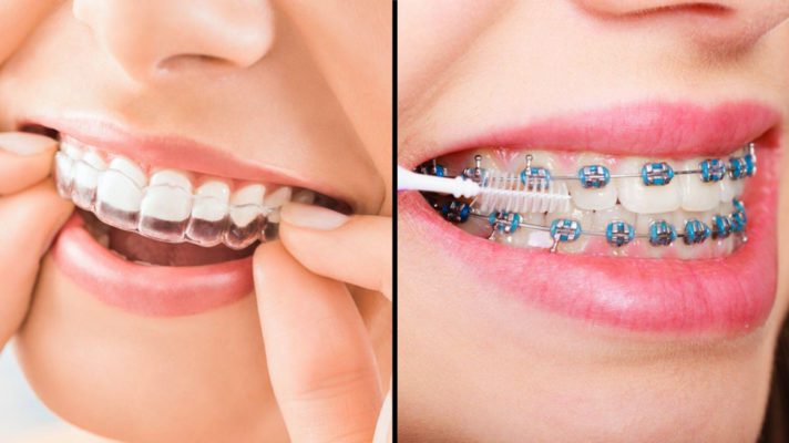 Bee Cave Orthodontics Invisalign for adults and kids in Austin