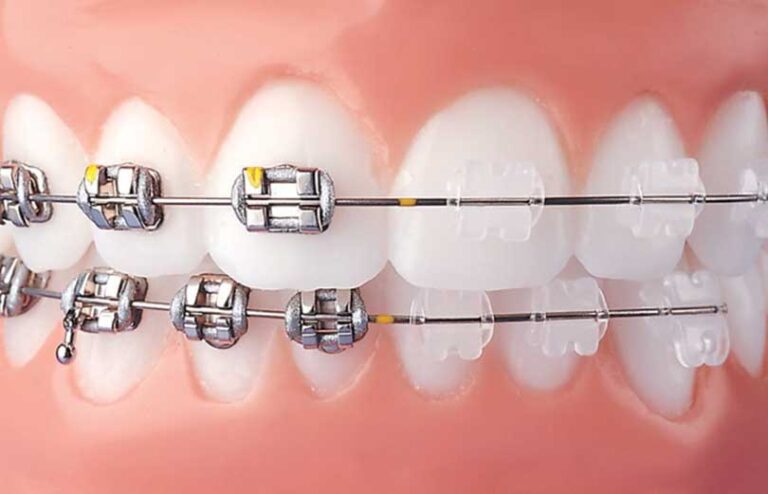 Braces Vs Invisalign - Summit Dental & Orthodontics