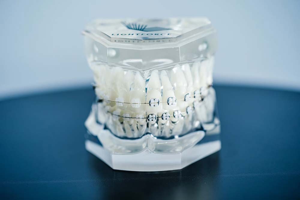 Translucent Braces Lightforce Braces: The Clear Choice for a Radiant Smile in Austin - Bee ...