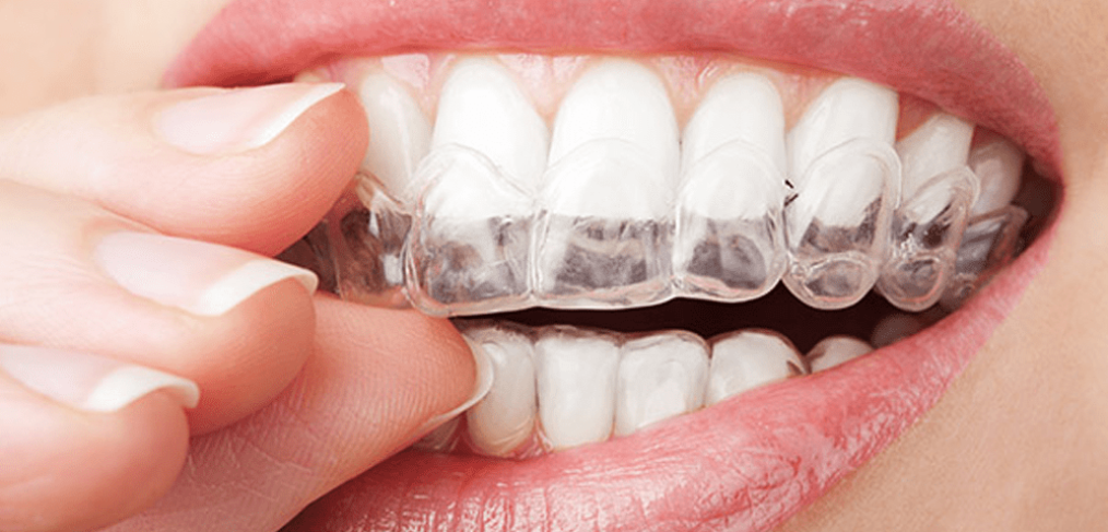 invisalign or braces