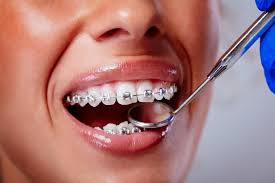 Summer-best-time-orthodontics beecaveortho.com