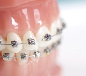 Bee Cave Orthodontics Invisalign for adults and kids in Austin