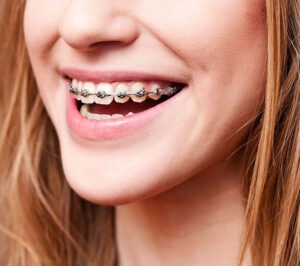 Bee Cave Orthodontics Invisalign for adults and kids in Austin